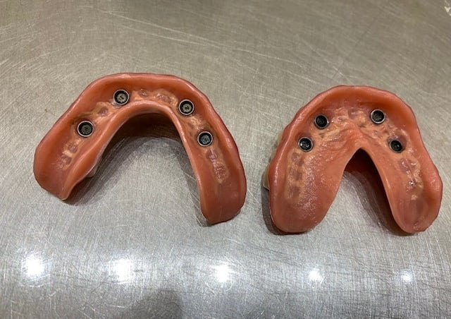 Sobredentadura sobre locators, all on 4