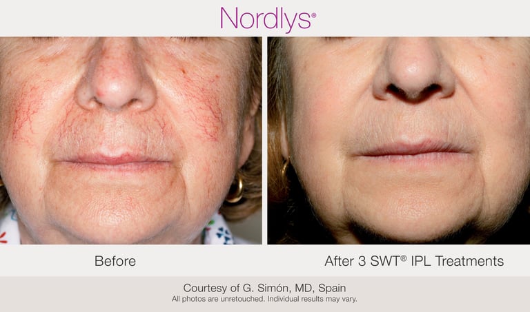 skin revitalization and rejuvenation before and after results in Hamilton skincare clinic