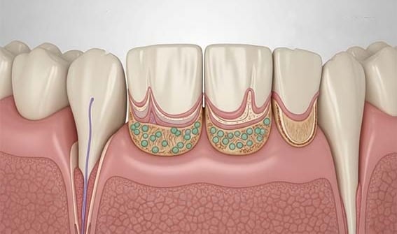 Alerte des dentistes sur les maladies des gencives hygiene-precision.com
