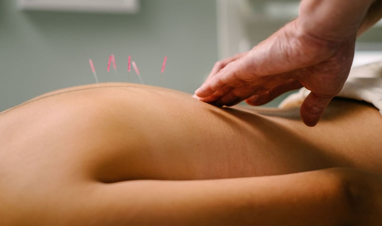 Professional acupuncture treatment showing needles in a patient's back for holistic pain relief.