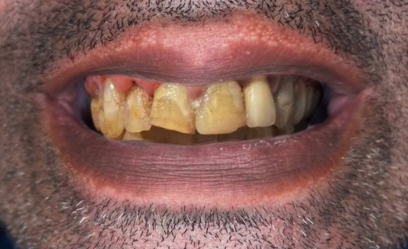 Before the All on 4 procedure