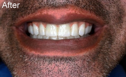 Pretteau Zirconia Superstructure