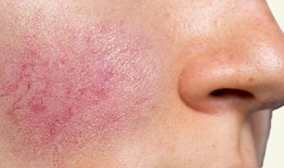 Rosacea in a young girl