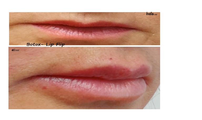 Before and after image of botox lip flip – fuller lips and reduced lines around the mouth.