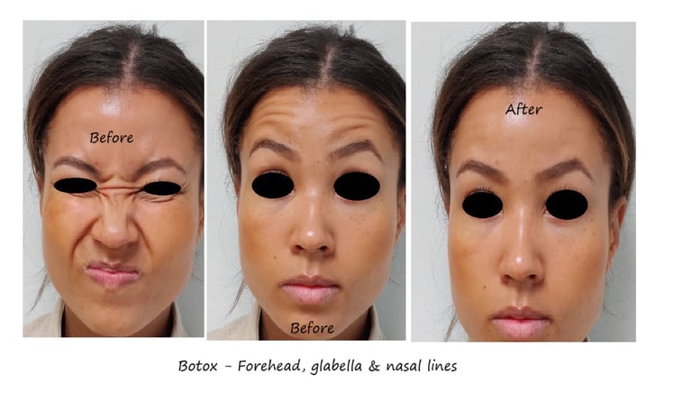 Före- och efterbild botox panna, näsa & glabella – jämnare överansikte och yngre utseende.