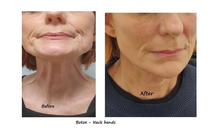 Före- och efterbild av botox i hals med reducerade nackband och ett mer ungdomligt utseende.