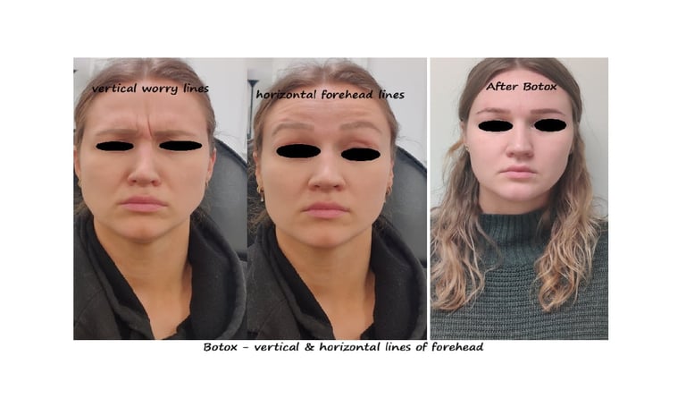 Botox panna & glabella före- och efterbild – slätare panna och ungdomligt utseende.