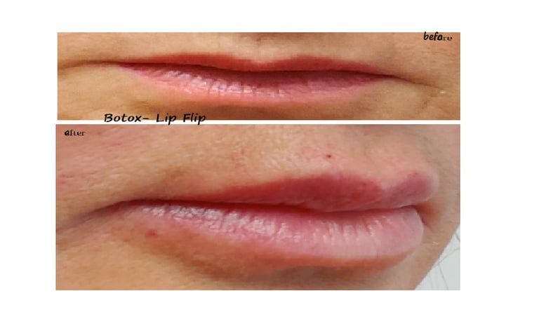 Före- och efterbild av botox lip flip – fylligare läppar och minskade linjer runt munnen.