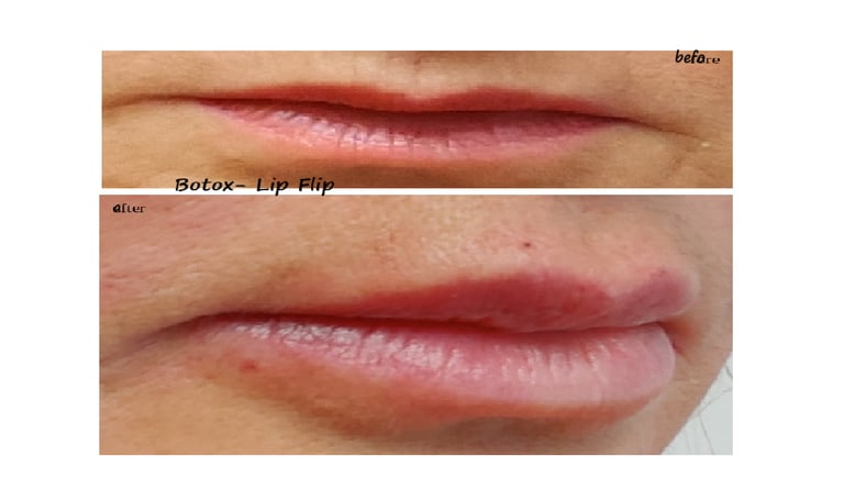 Före- och efterbild av botox lip flip – fylligare läppar och minskade linjer runt munnen.