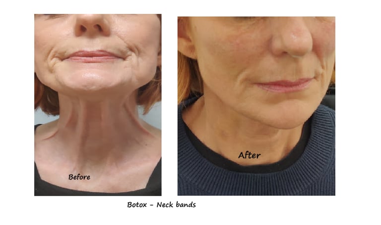 Före- och efterbild av botox i hals – reducerade nackband och ett mer ungdomligt utseende.