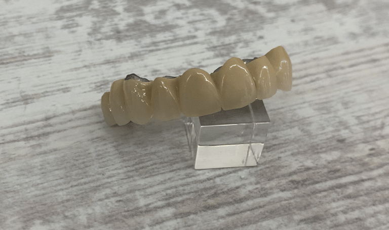 rehabilitación superior metal cerámica