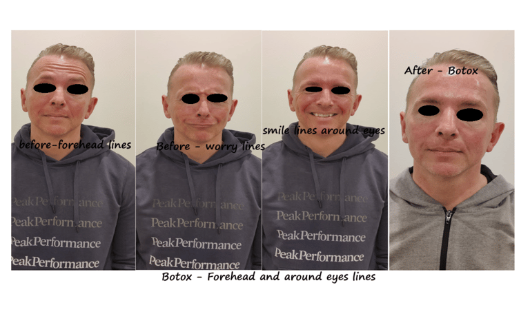 Before and after image of botox in forehead, glabella and around eyes: reduced wrinkles..