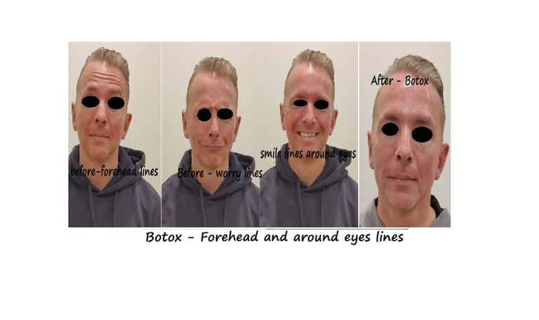 Botox i panna, glabella och ögon före- och efterbild – minskning av linjer och ungdomligt utseende.