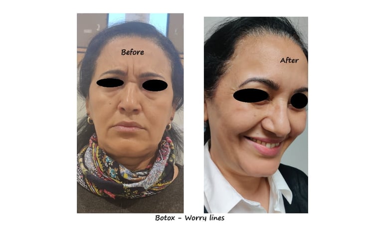 Före- & efterbild botox bekymmersrynkor – slätare glabella & avslappnat uttryck.