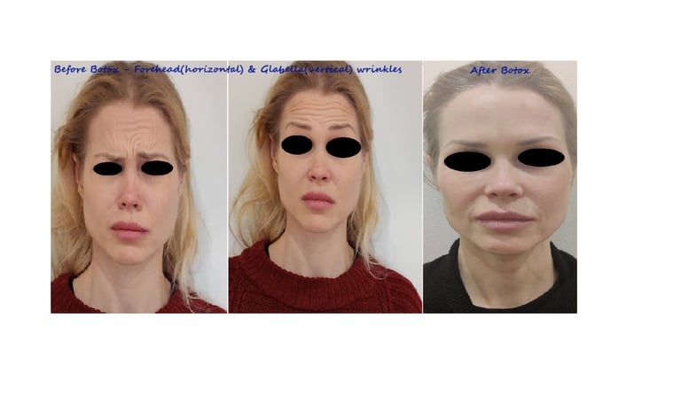 Före- och efterbild botox panna & glabella – reducerade rynkor & jämnare utseende