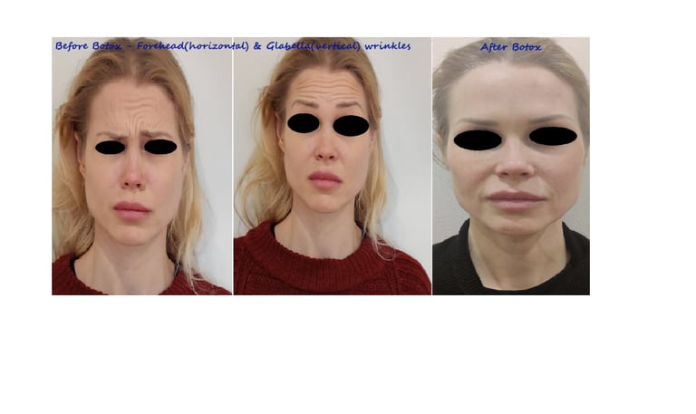 Före- och efterbild botox panna & glabella – reducerade rynkor & jämnare utseende