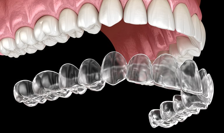 Modello di Invisalign - Gambara 