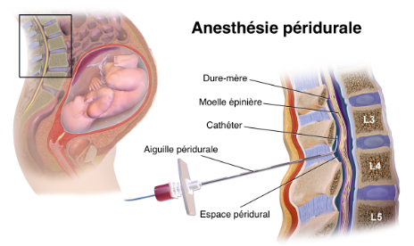 anesthésie péridurale