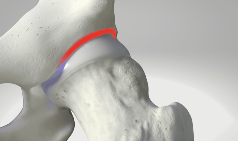 Artroscopia do quadril