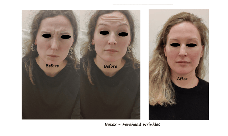 Botoxbehandling i panna och glabella – före- och efterbild som visar reducerade rynkor
