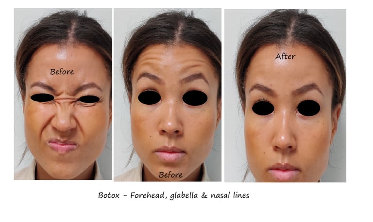 Före- och efterbild botox panna, näsa & glabella – jämnare överansikte och yngre utseende.