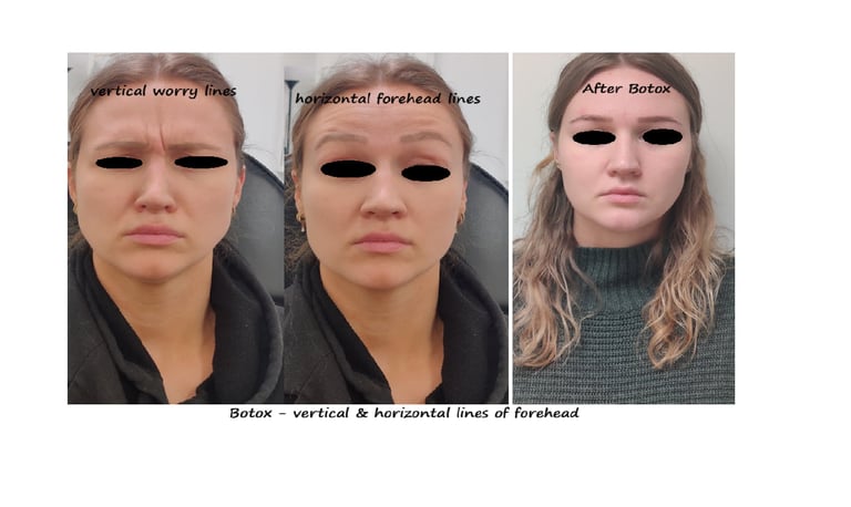 Botox panna & glabella före- och efterbild – slätare panna och ungdomligt utseende.