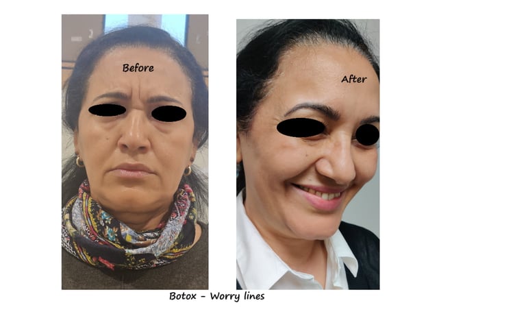 Före- & efterbild botox bekymmersrynkor – slätare glabella & avslappnat uttryck.