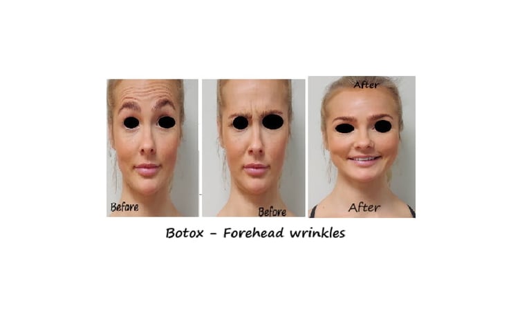 Botox i panna och glabella före- och efterbild – reducerade rynkor och ungdomligt utseende.
