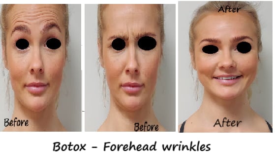Botox i panna och glabella före- och efterbild – reducerade rynkor och ungdomligt utseende.