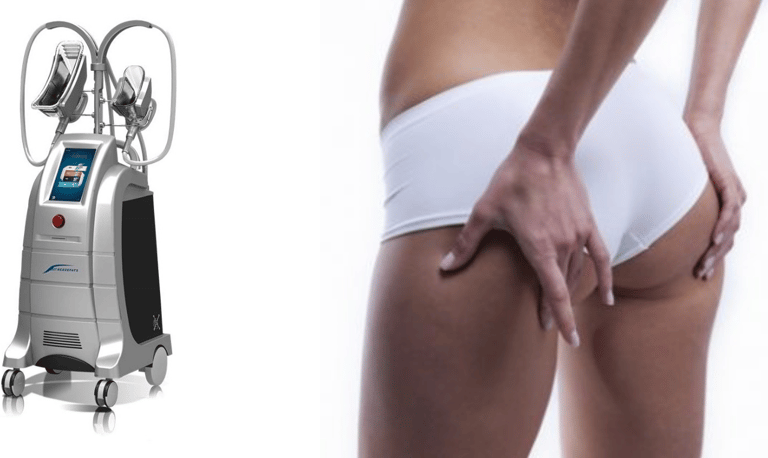 Cryolipolise, minceur