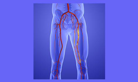 vascular ultrasound artery atherosclerosis stenosis disease stent bypass graft leg pain walking claudication peripheral block