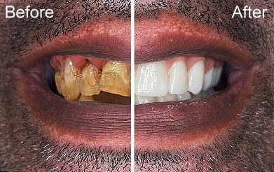 all-on-4-dental-procedure-in-mexico