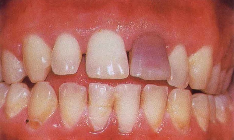 a image showing upper left central incisor with brown pink tooth discoloration