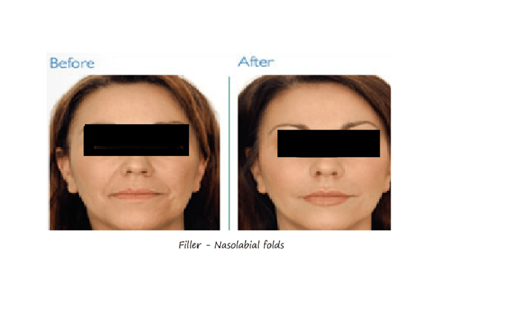 Filler nasolabial folds before and after – smoother skin and younger appearance after correction.