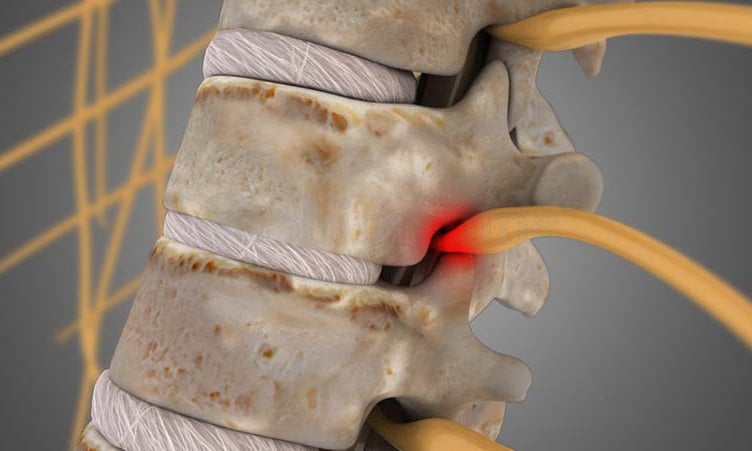 Dr.Rajinikanth's ortho clinic lumbar spondylosis