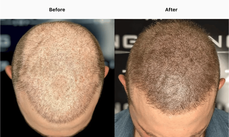 Best Scalp Micropigmentation Toronto_ATRUBARBER