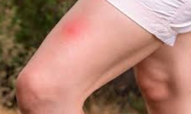Complete Guide to Bee Stings  Treatment option , 
