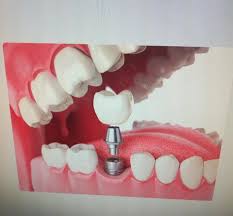 Modèle d'implant : vis titane et couronne céramique dans une mâchoire.