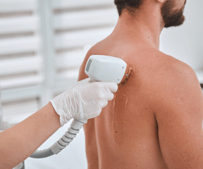 Homme recevant une Épilation laser du dos