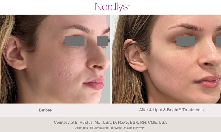 esthetician performing acne and congestion treatment for healthy skin in Hamilton clinic
