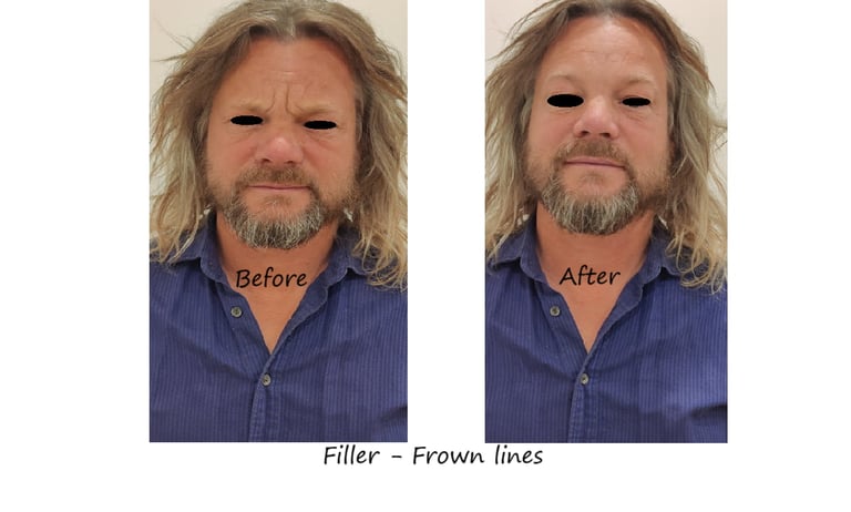 Before and after photos filler glabella – smoother frown lines, youthful appearance without swelling