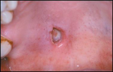 patologias de glândulas salivares resumo patologia bucal sialometaplasia necrosante