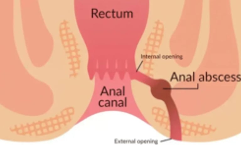 🍯Anal Fissures and Fistulas try honey first