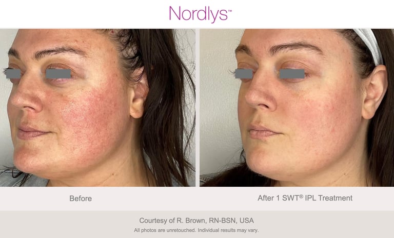 skin analysis and consultation for treatment planning in Hamilton skincare clinic