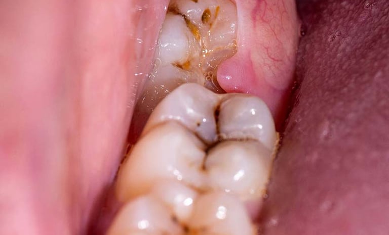 a image showing impacted wisdom tooth
