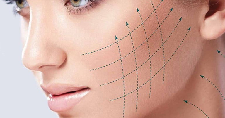 microlifting fire rezorbabile