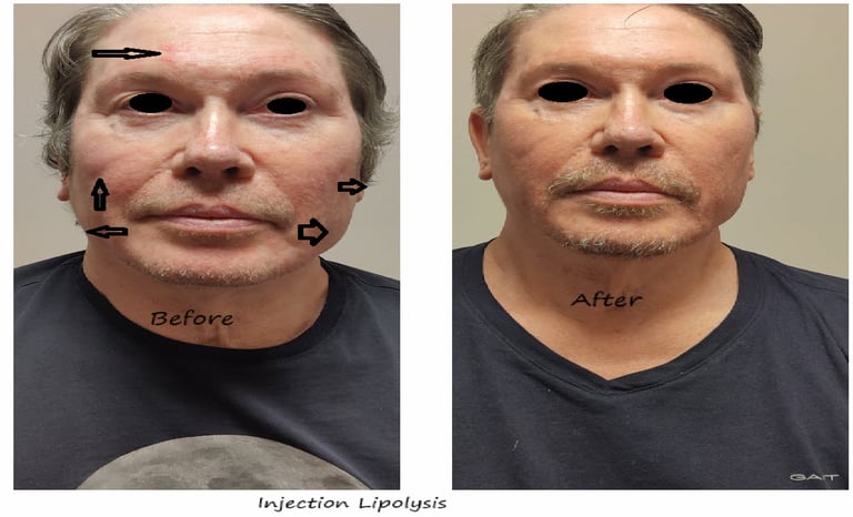 Fat reduction Delhi before and after photo – injection lipolysis face for fat nodules.