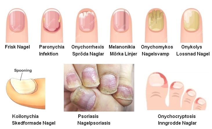 Nail Diseases