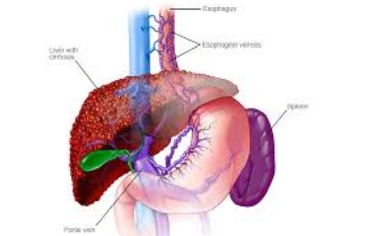 Esophageal Varices: A Comprehensive Guide to Managements