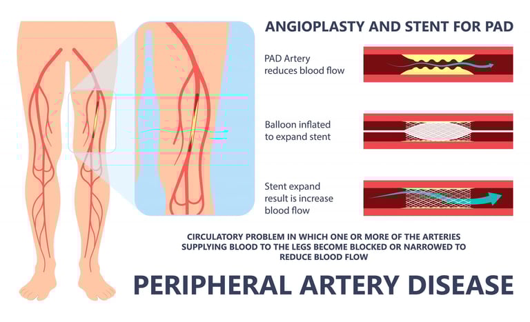 Peripheral artery bypass surgery
